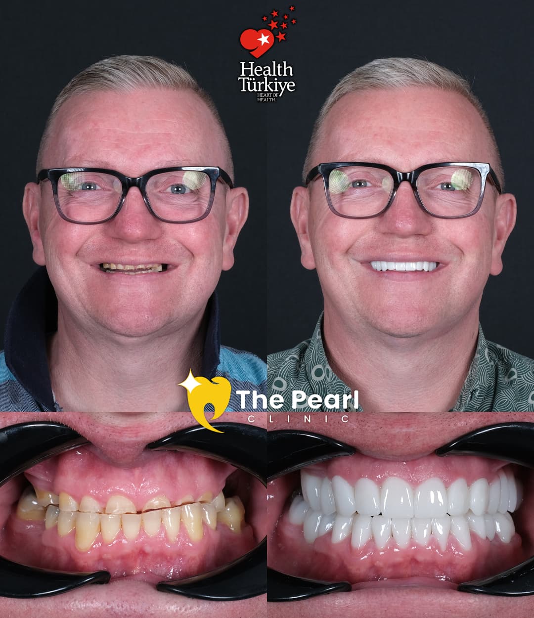 Full Mouth Transformation